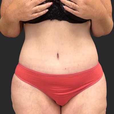 After — result 3, Dr. Guy Rasner