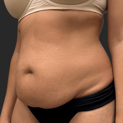Before — result 10, Dr. Guy Rasner