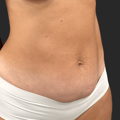 Before — result 1, Dr. Guy Rasner