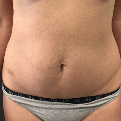 Before — result 11, Dr. Guy Rasner